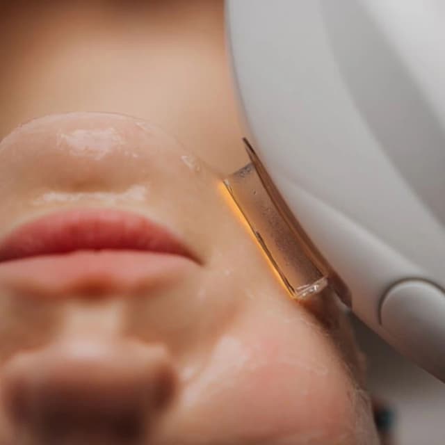 IPL Facial Package at Liberty Health and Beauty in Waterville, ME